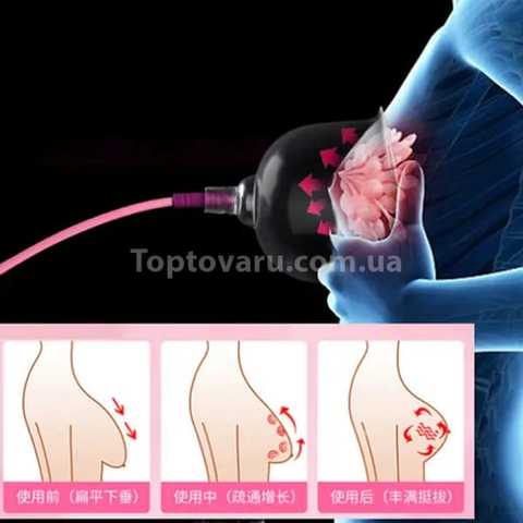 Вакуумная терапия в коррекции формы груди